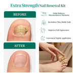 Apuree overnight nail repair patches before and after results showing improvement in damaged and thick nails