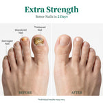 APUREE Nailtific OTC antifungal solution for toenail fungus treatment before and after results