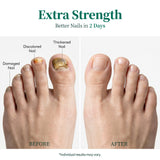 APUREE Nailtific OTC antifungal solution for toenail fungus treatment before and after results