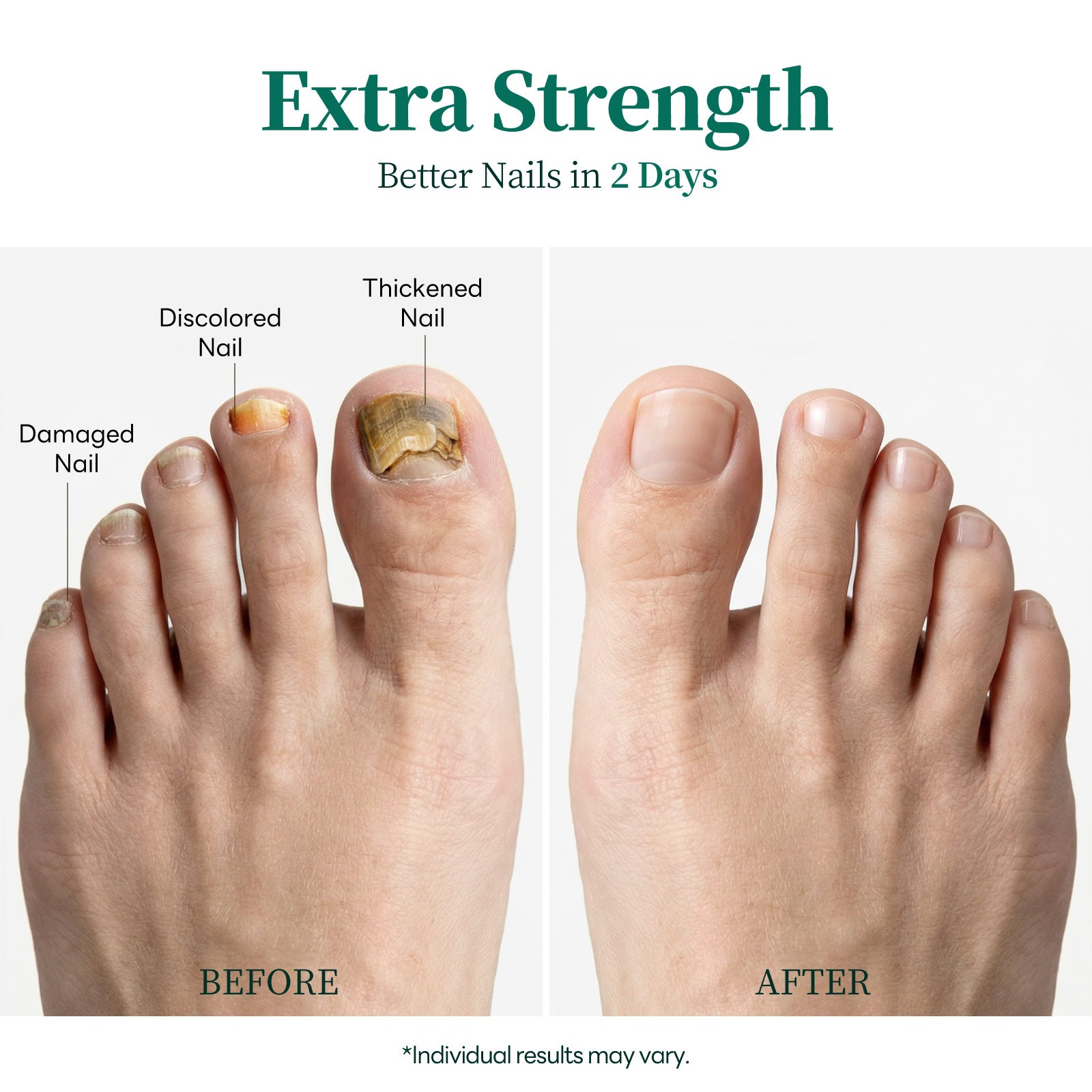 APUREE Nailtific OTC antifungal solution for toenail fungus treatment before and after results