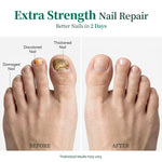 Apuree antifungal toenail treatment before and after results for damaged thickened nails repair