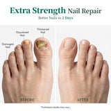 Apuree antifungal toenail treatment before and after results for damaged thickened nails repair