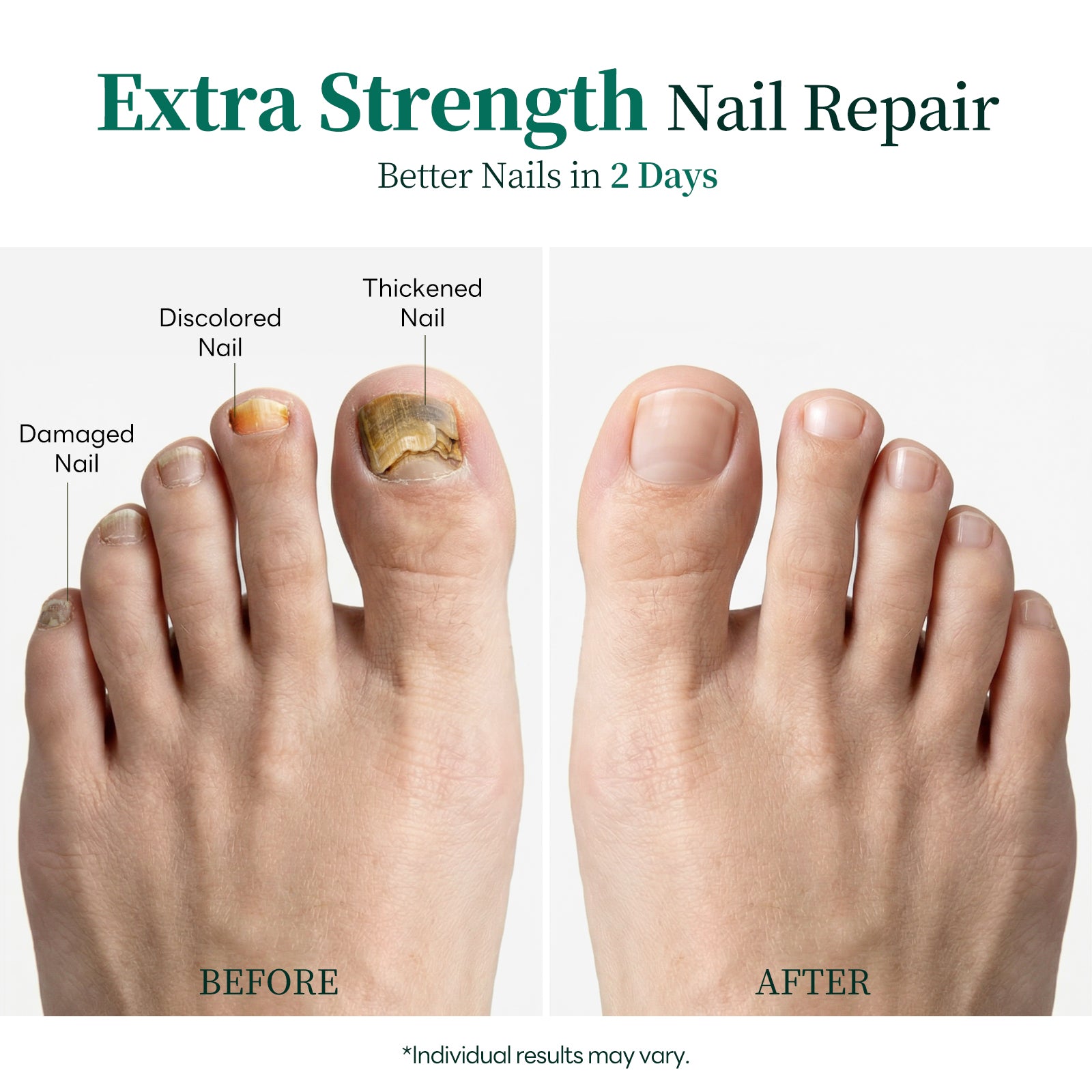Apuree antifungal toenail treatment before and after results for damaged thickened nails repair