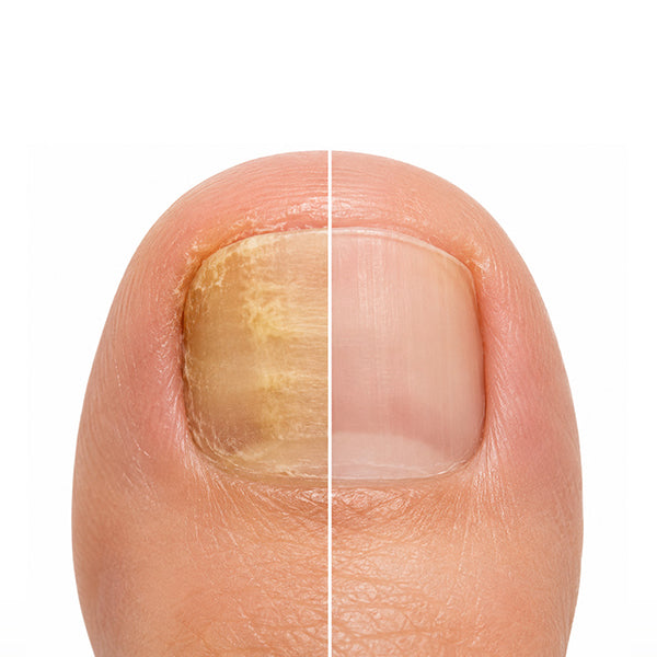 APUREE Antifungal Liquid Day & Night System Kit Visible Action Before After Nail Appearance Comparison