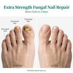 Apuree toenail fungus treatment before and after visible nail repair results daytime care