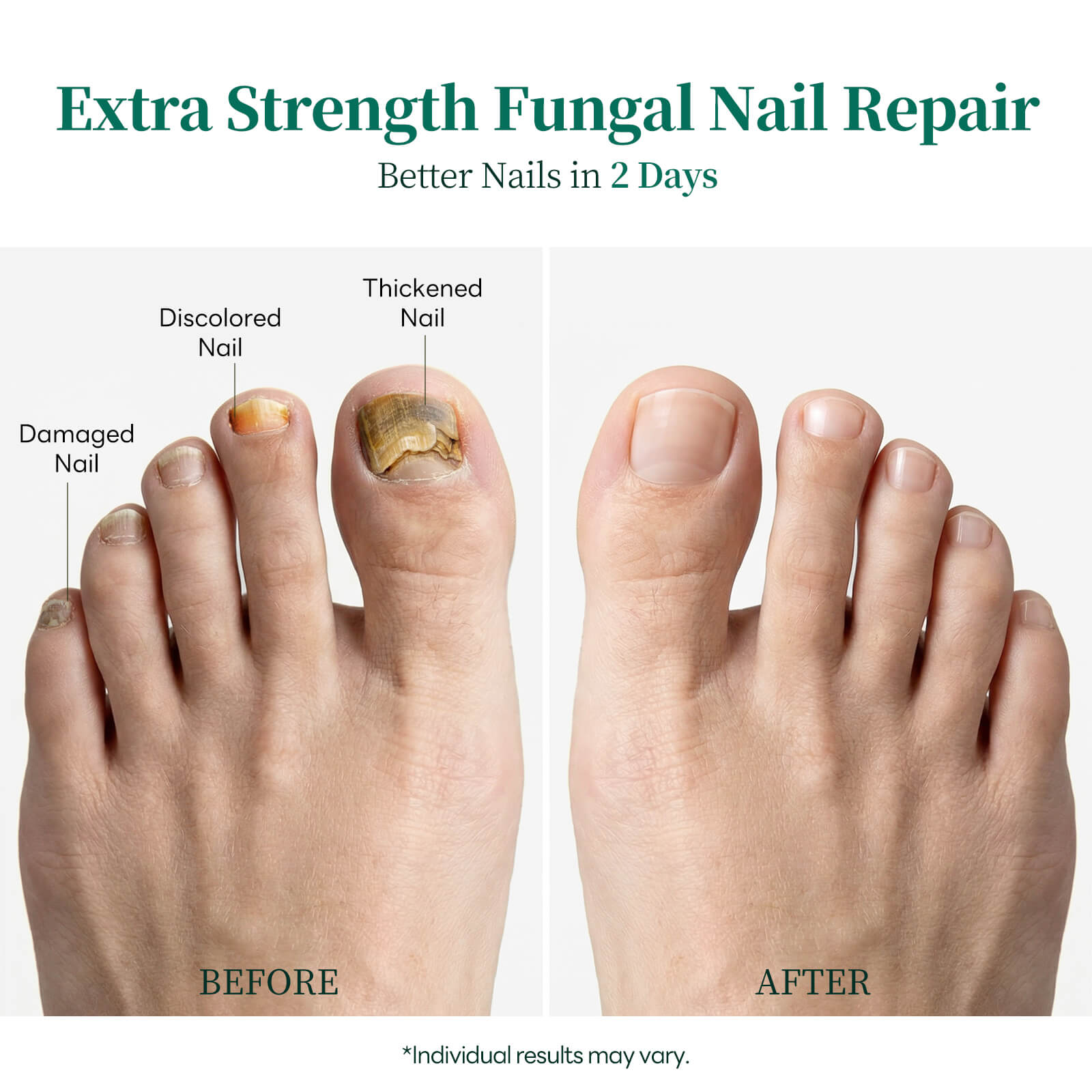 Apuree toenail fungus treatment before and after visible nail repair results daytime care
