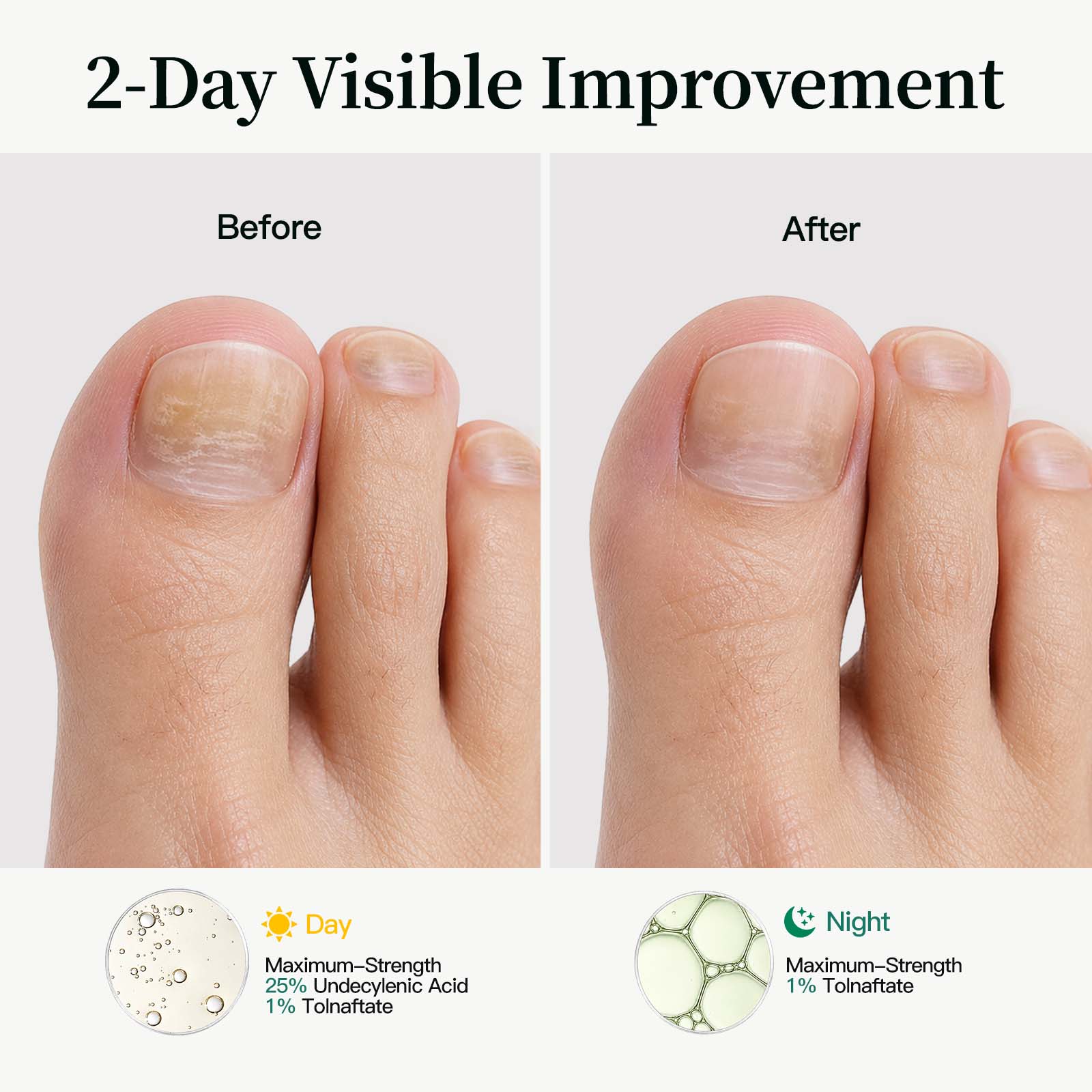 APUREE Antifungal Liquid Day & Night System Kit 2-Day Visible Action Before After Nail Appearance Comparison