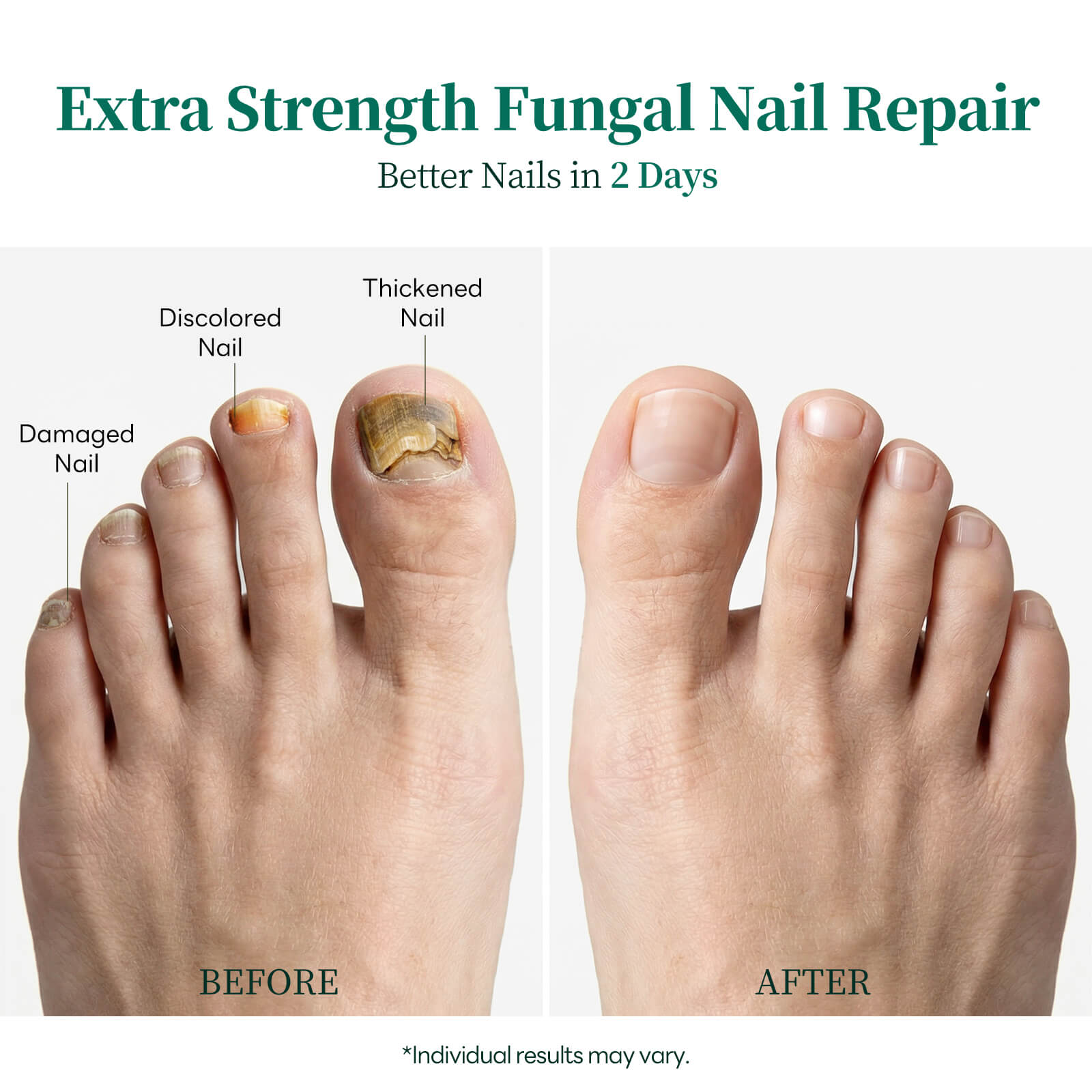 Apuree toenail fungus treatment before and after results overnight deep nail repair improvement