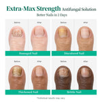 APUREE antifungal Undecylenic Acid nail treatment showing visible improvement for damaged, discolored and brittle nails