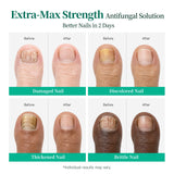 APUREE antifungal Undecylenic Acid nail treatment showing visible improvement for damaged, discolored and brittle nails