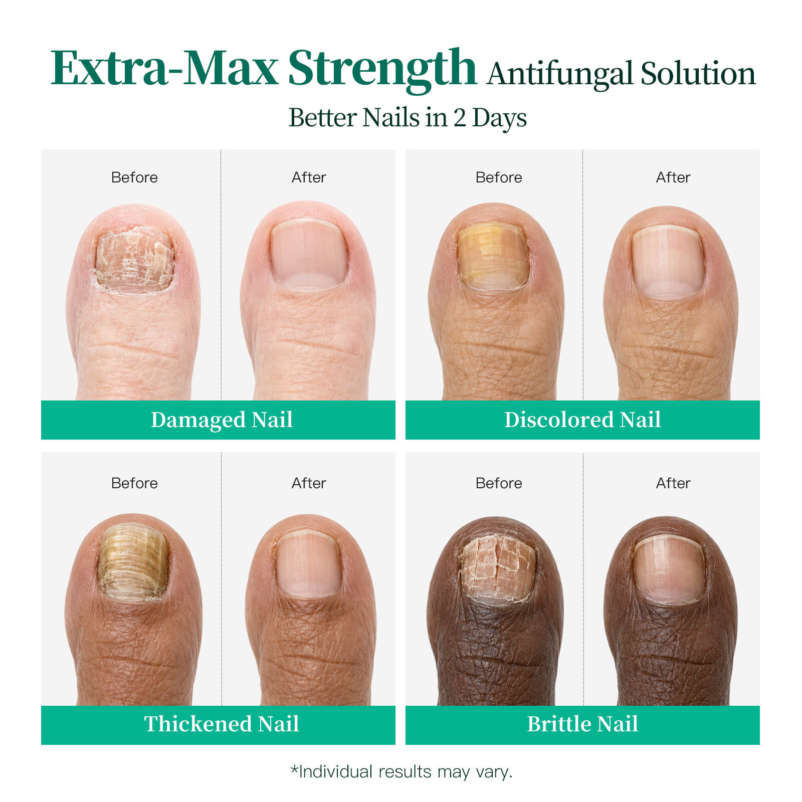 APUREE antifungal Undecylenic Acid nail treatment showing visible improvement for damaged, discolored and brittle nails