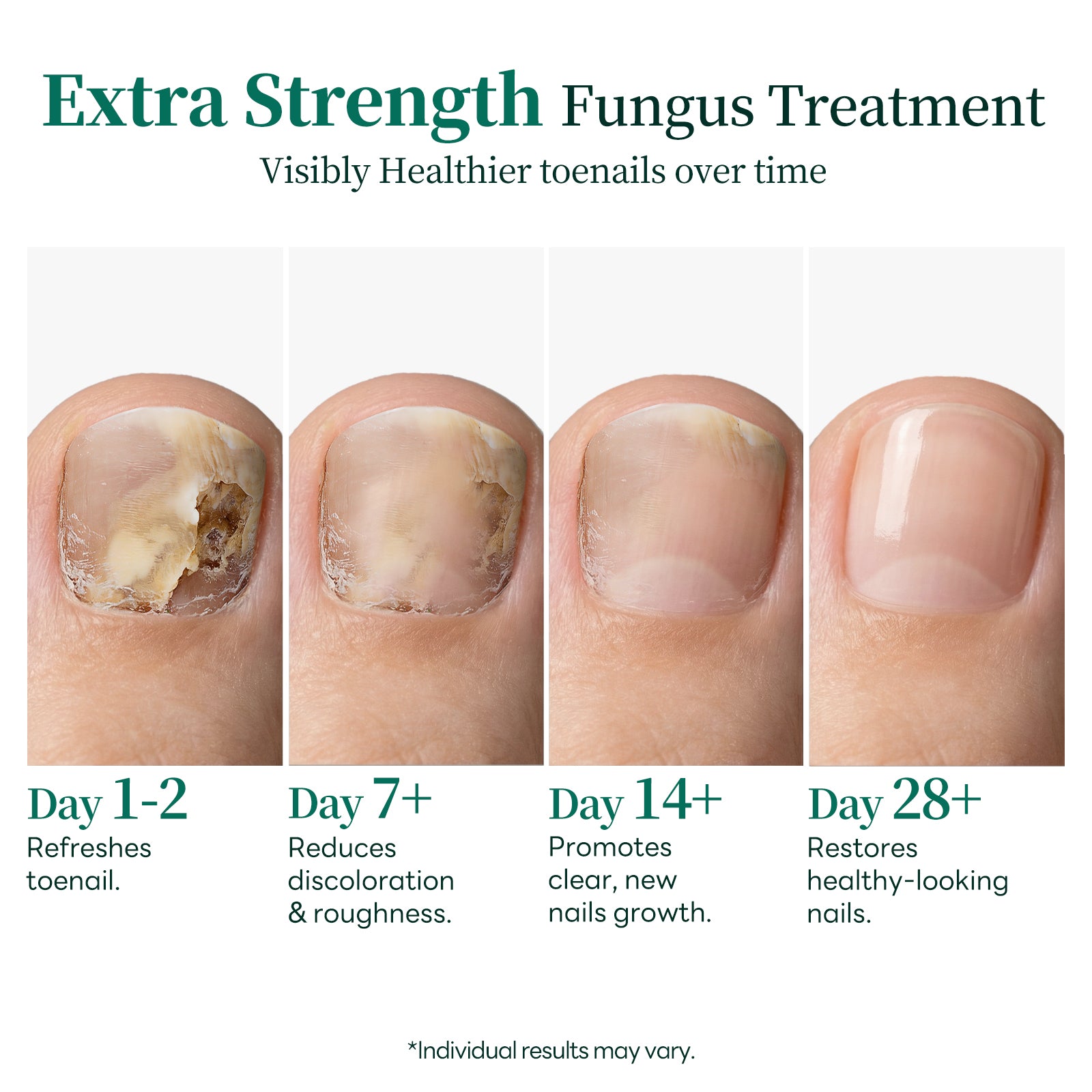 Apuree toenail fungus treatment progress timeline day 1 to day 28 healthy nail recovery stages
