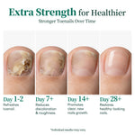 APUREE antifungal undecylenic acid treatment showing nail improvement timeline day 1 to day 28