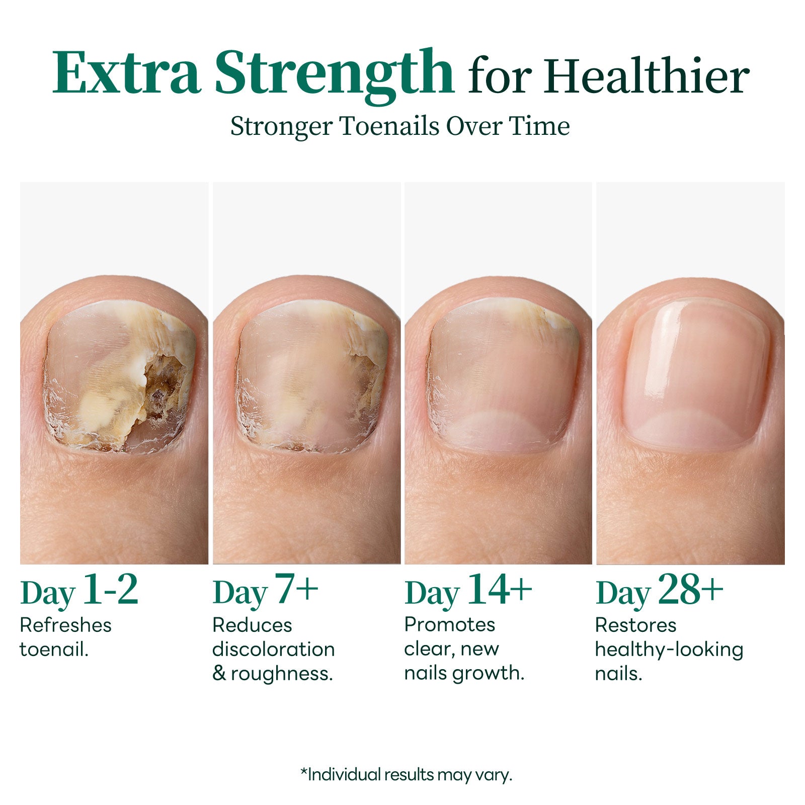APUREE antifungal undecylenic acid treatment showing nail improvement timeline day 1 to day 28