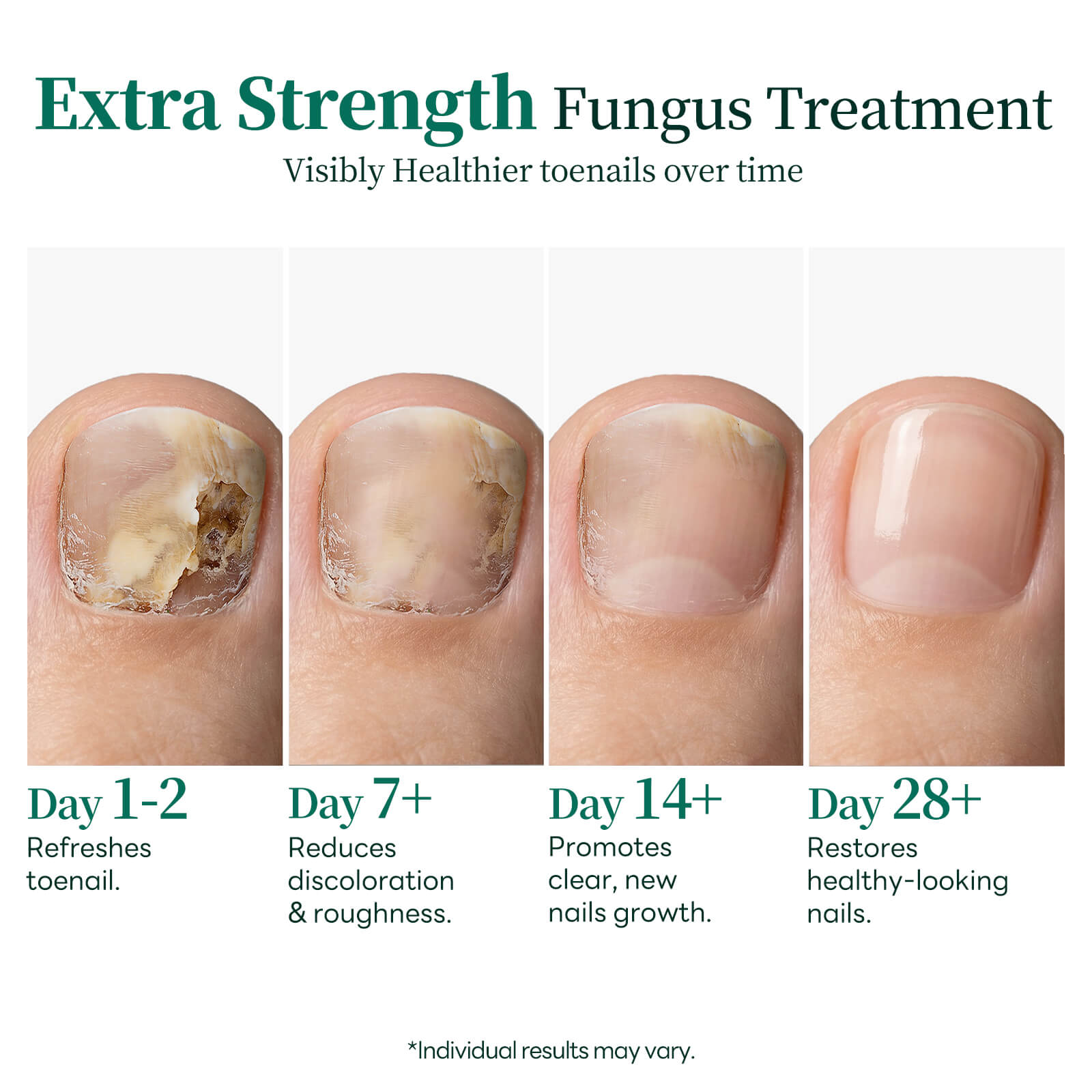 Apuree toenail fungus treatment progress timeline daytime use visible nail recovery stages