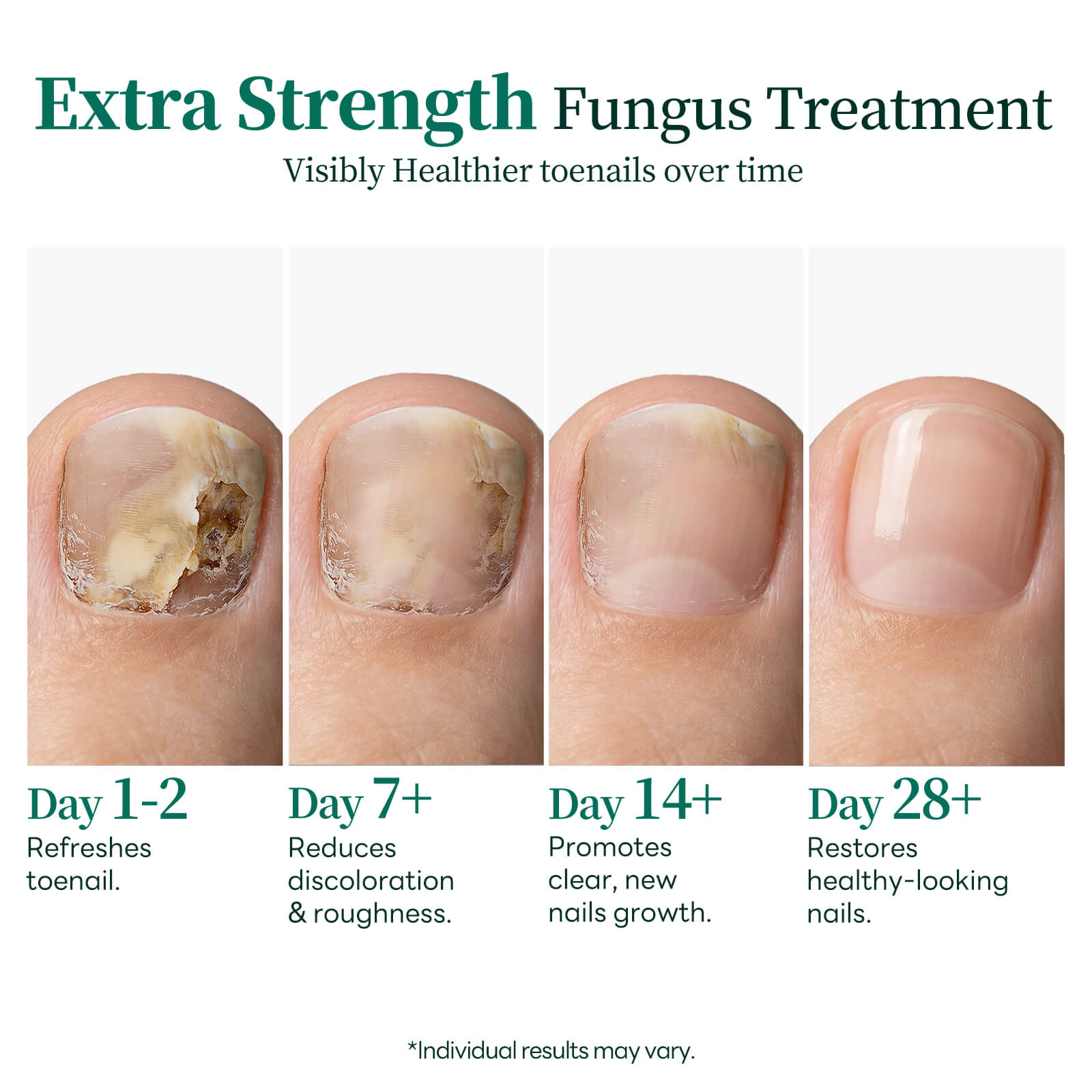 Apuree toenail fungus treatment progress timeline overnight repair visible nail recovery stages