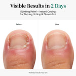 APUREE maximum strength nail fungus patches pro visible toenail results in 2 days with cooling menthol
