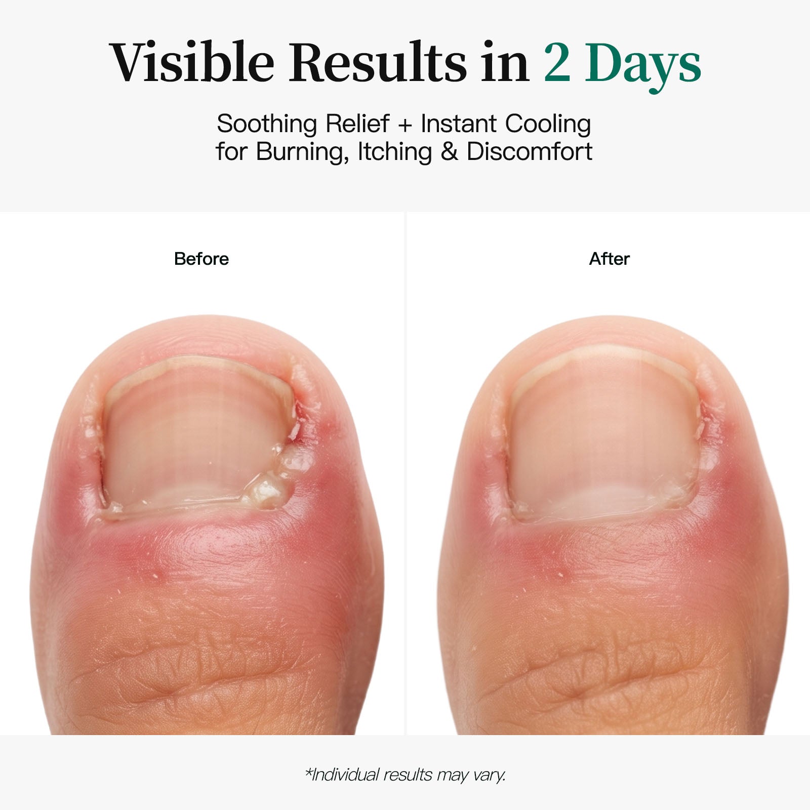APUREE maximum strength nail fungus patches pro visible toenail results in 2 days with cooling menthol
