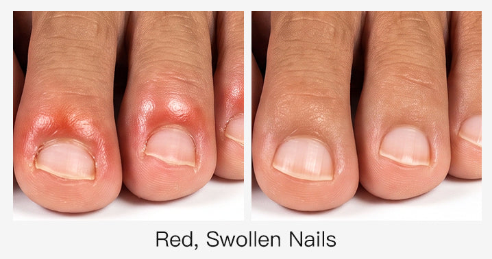 APUREE-red-swollen-itchy-big-toe